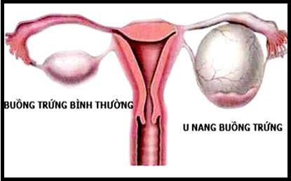 Chữa trị bệnh u nang buồng trứng tại Tp Vinh Nghệ An